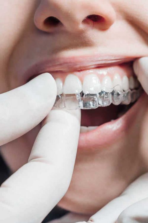 invisalign